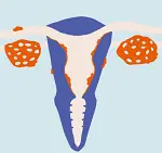 子宮内膜症